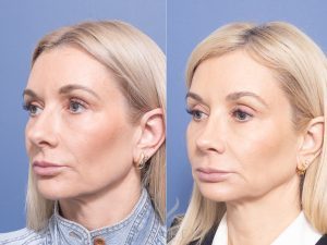 Rhinoplasty Dr Raymond Goh