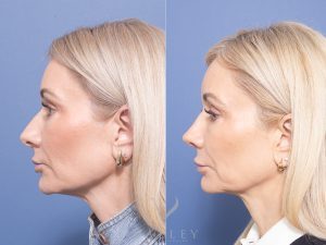 Rhinoplasty Dr Raymond Goh