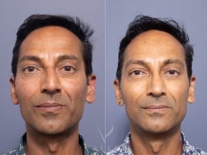 Septorhinoplasty Dr Raymond Goh