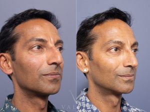 Septorhinoplasty Dr Raymond Goh