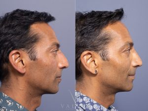 Septorhinoplasty Dr Raymond Goh