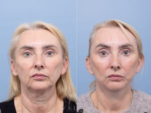 Deep plane face and neck lift, lower blepharoplasty skin pinch Dr Adam Honeybrook