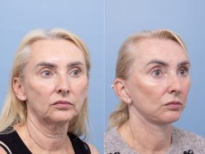 Deep plane face and neck lift, lower blepharoplasty skin pinch Dr Adam Honeybrook