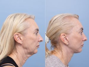 Deep plane face and neck lift, lower blepharoplasty skin pinch Dr Adam Honeybrook