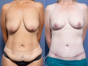 Circumferential lipectomy + Bilateral Breast Reduction Dr Raymond Goh