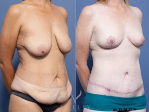 Circumferential lipectomy + Bilateral Breast Reduction Dr Raymond Goh