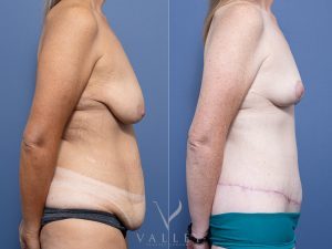 Circumferential lipectomy + Bilateral Breast Reduction Dr Raymond Goh