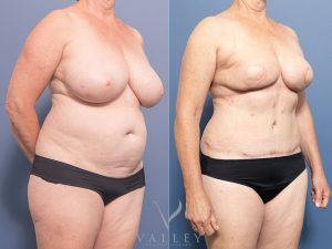 Mastectomy with DIEP breast reconstruction Dr Chris Jardim