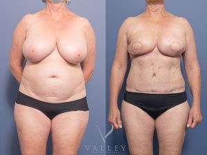 Mastectomy with DIEP breast reconstruction Dr Chris Jardim