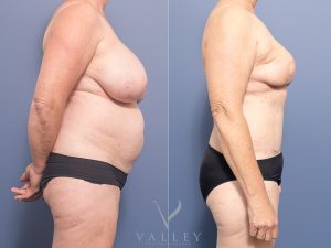 Mastectomy with DIEP breast reconstruction Dr Chris Jardim