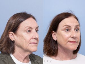 Deep plane face and neck lift Dr Adam Honeybrook