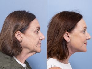 Deep plane face and neck lift Dr Adam Honeybrook