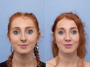 Septorhinoplasty Dr Adam Honeybrook