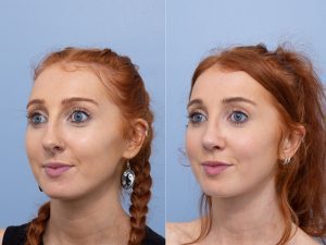 Septorhinoplasty Dr Adam Honeybrook