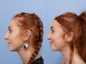 Septorhinoplasty Dr Adam Honeybrook