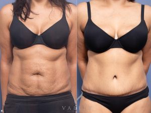 Abdominoplasty Dr Raymond Goh