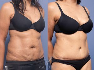Abdominoplasty Dr Raymond Goh