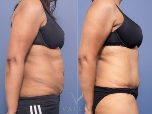 Abdominoplasty Dr Raymond Goh