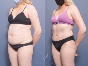 Abdominoplasty Dr Chris Jardim