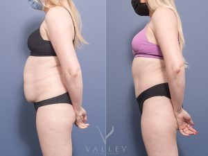 Abdominoplasty Dr Chris Jardim