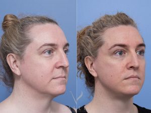 Deep plane face and neck lift, subnasal lip lift Dr Adam Honeybrook