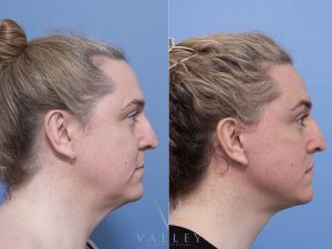 Deep plane face and neck lift, subnasal lip lift Dr Adam Honeybrook