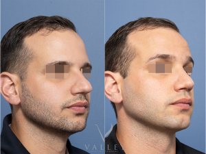 Septorhinoplasty Dr Raymond Goh