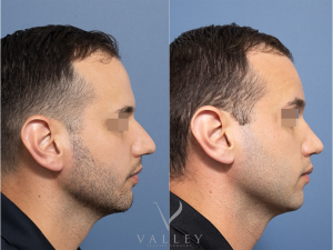 Septorhinoplasty Dr Raymond Goh