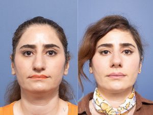 Rhinoplasty Dr Raymond Goh