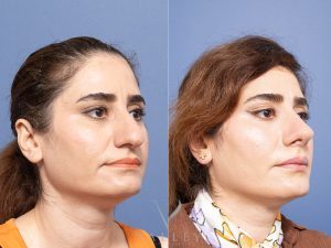 Rhinoplasty Dr Raymond Goh