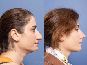 Rhinoplasty Dr Raymond Goh