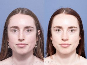 Septorhinoplasty Dr Raymond Goh