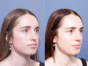 Septorhinoplasty Dr Raymond Goh