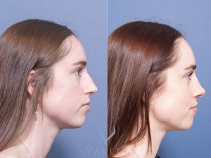 Septorhinoplasty Dr Raymond Goh
