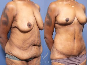 Bilateral breast reduction and abdominoplasty Dr Chris Jardim