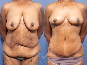 Bilateral breast reduction and abdominoplasty Dr Chris Jardim