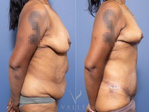 Bilateral breast reduction and abdominoplasty Dr Chris Jardim