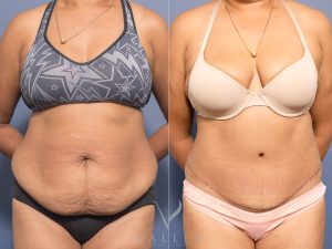 Abdominoplasty Dr Chris Jardim