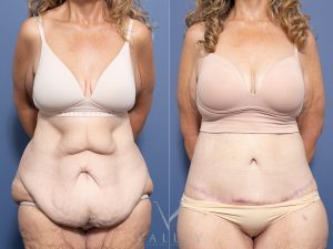 Circumferential Lipectomy Dr Raymond Goh
