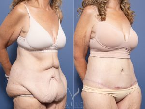 Circumferential Lipectomy Dr Raymond Goh