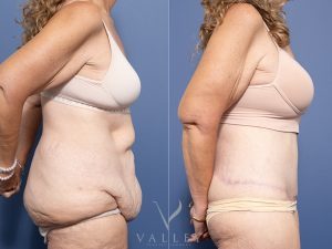 Circumferential Lipectomy Dr Raymond Goh