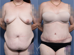 Abdominoplasty Dr Raymond Goh