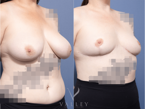 Bilateral Breast Reduction Dr Raymond Goh