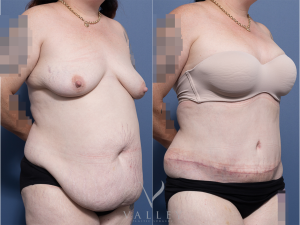 Abdominoplasty Dr Raymond Goh