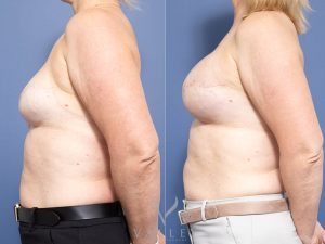R breast mastectomy with tissue expander to implant reconstruction & L breast implant removal and replacement Dr Chris Jardim