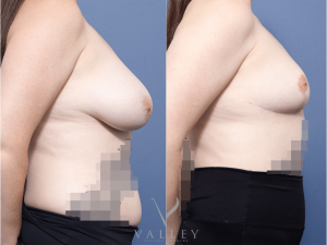 Bilateral Breast Reduction Dr Raymond Goh