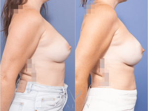 Remove & replace bilateral implants & capsulectomy Dr Raymond Goh