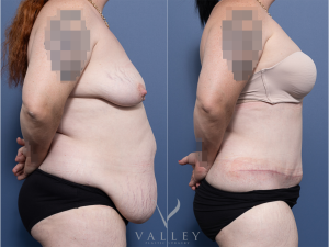 Abdominoplasty Dr Raymond Goh