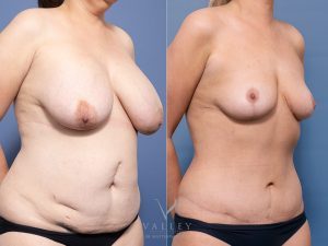 1 - Abdominoplasty Gallery 2