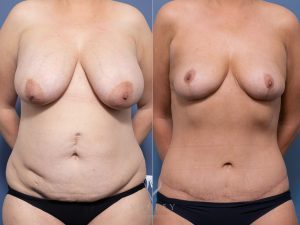 2 - Abdominoplasty Gallery 1